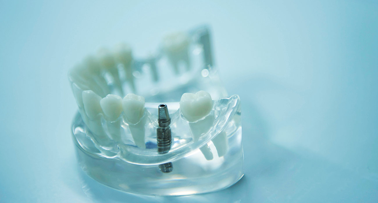 Implantate: Zähne naturnah ersetzen